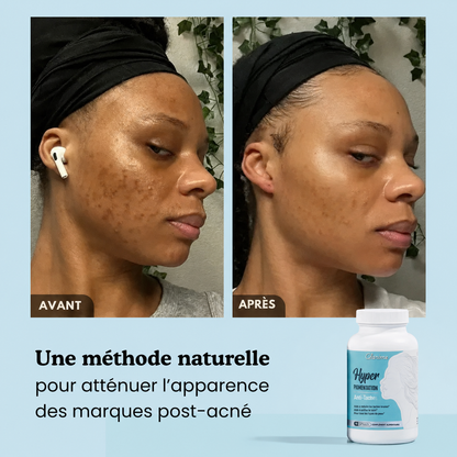 Hyperpigmentation Anti-Taches