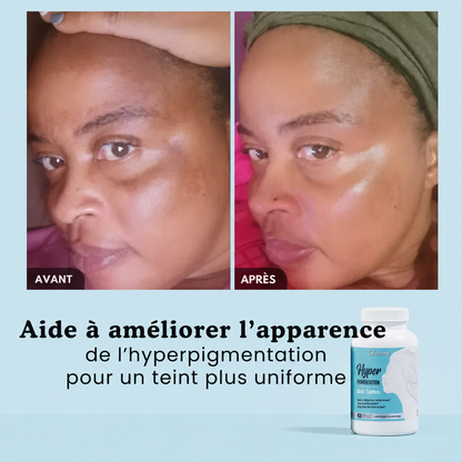 Hyperpigmentation Anti-Taches