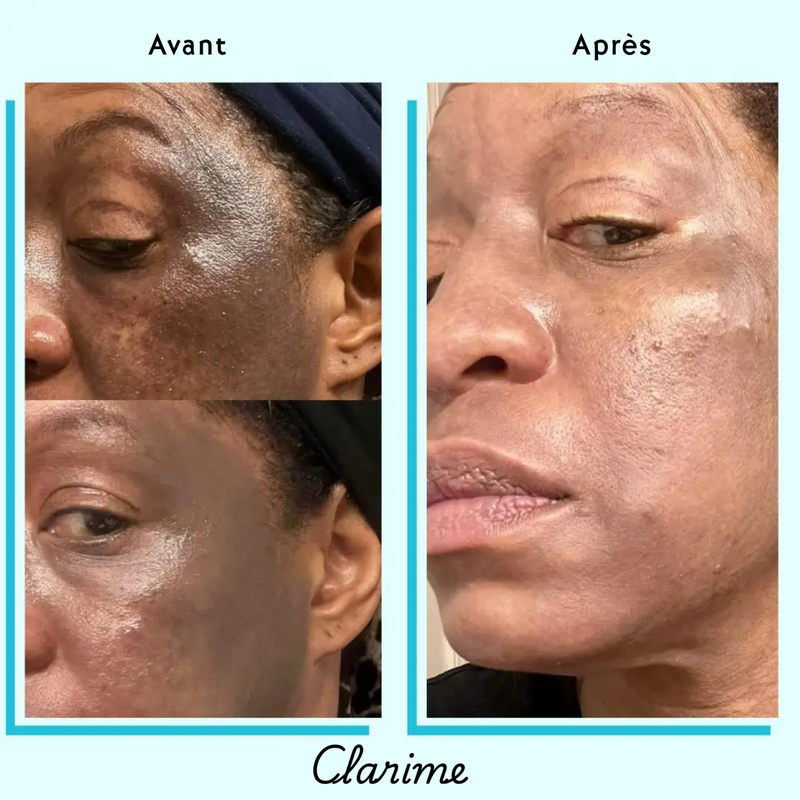 Aïssatou — before and after