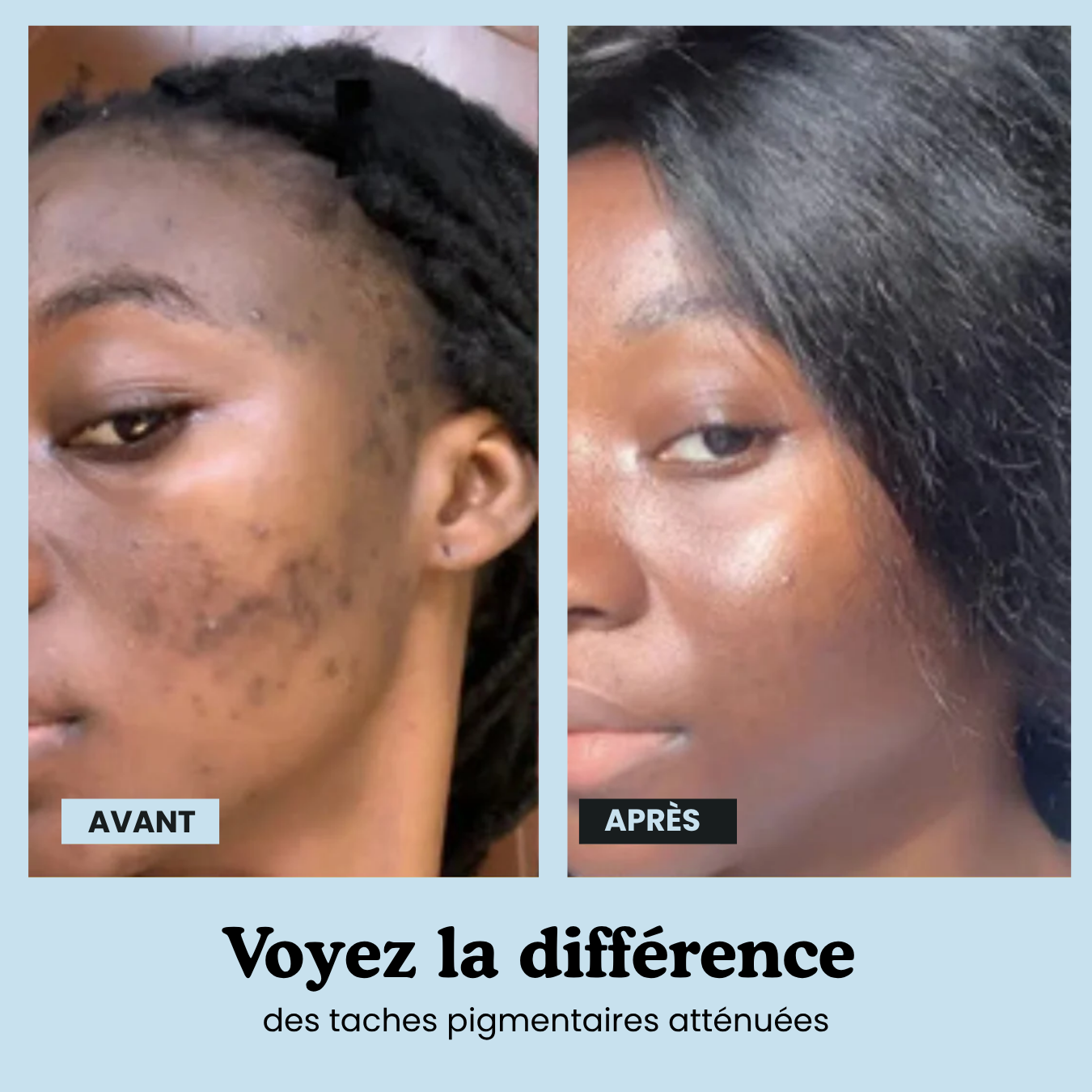Hyperpigmentation Anti-Taches