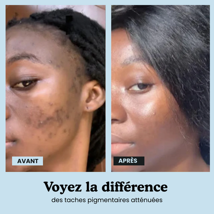 Hyperpigmentation Anti-Taches