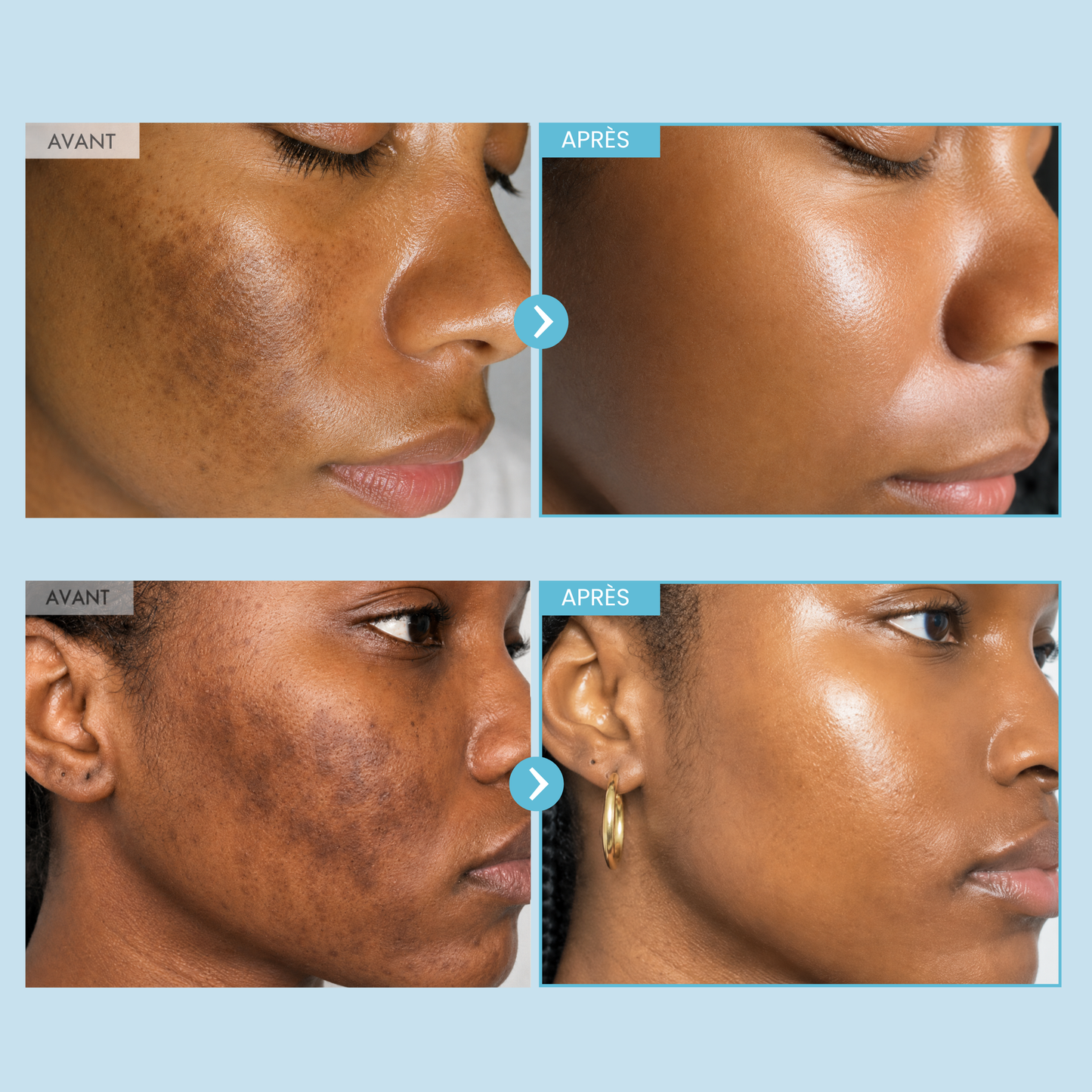 Hyperpigmentation Anti-Taches