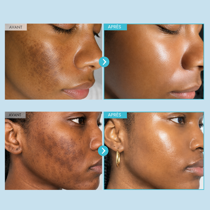 Hyperpigmentation Anti-Taches (Copy)