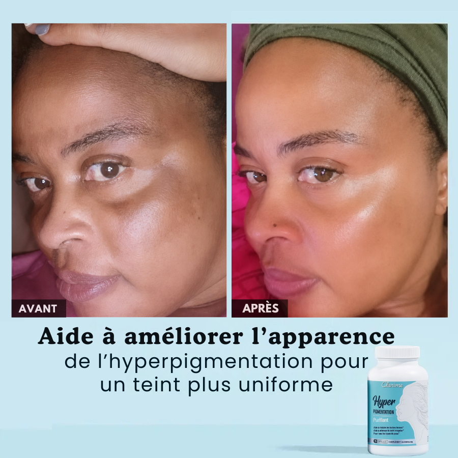Hyperpigmentation Anti-Taches
